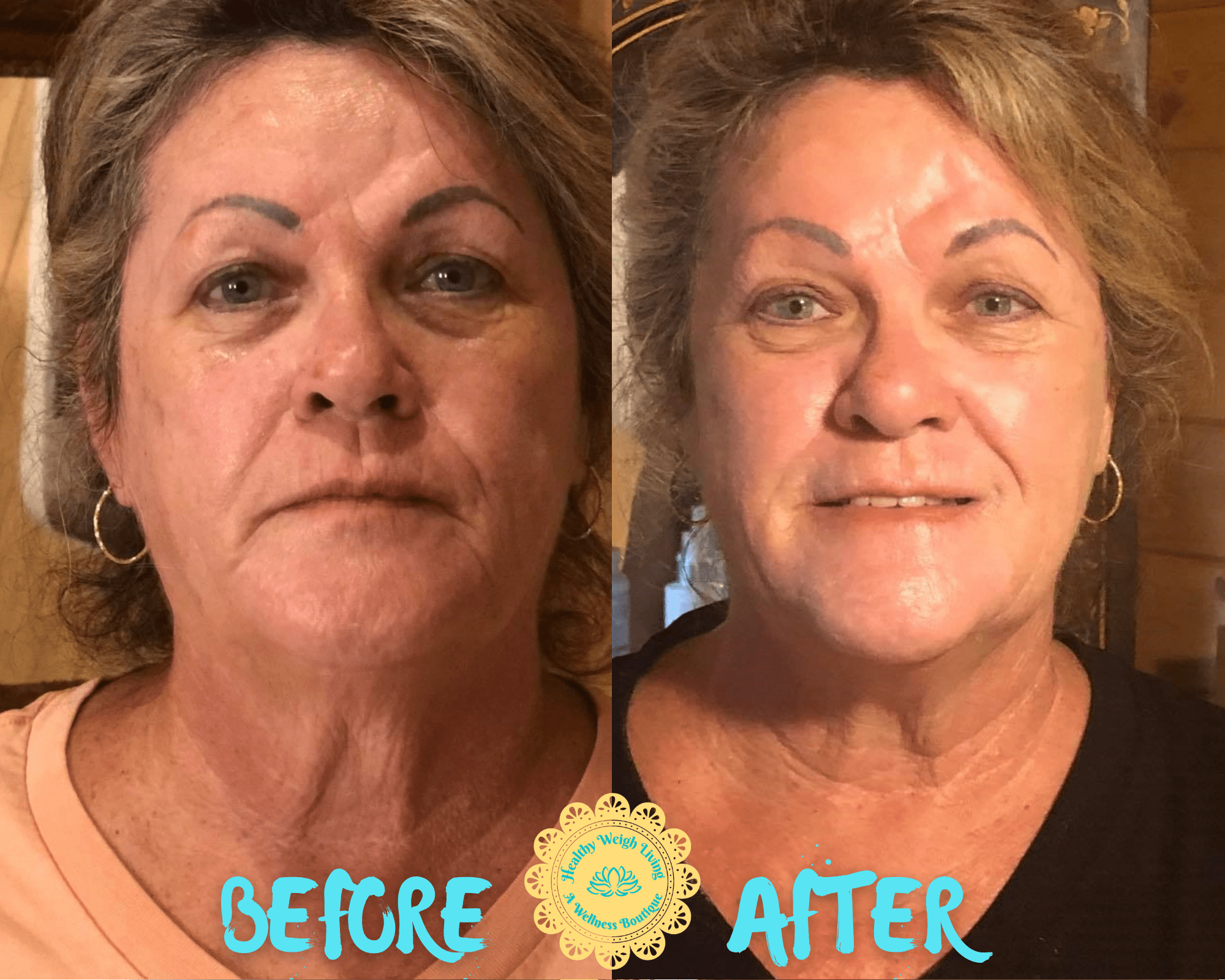 Infrared Thermal Facelift Anti Aging Treatment The Villages Fl 4524